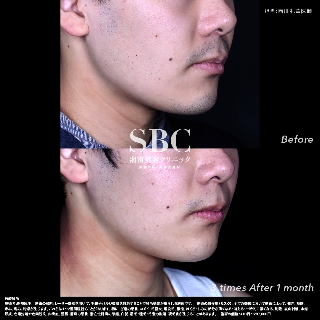 Before-After