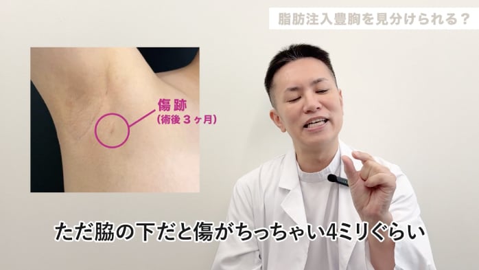 脂肪豊胸のプロから見て、豊胸済みのバストはわかりますか？