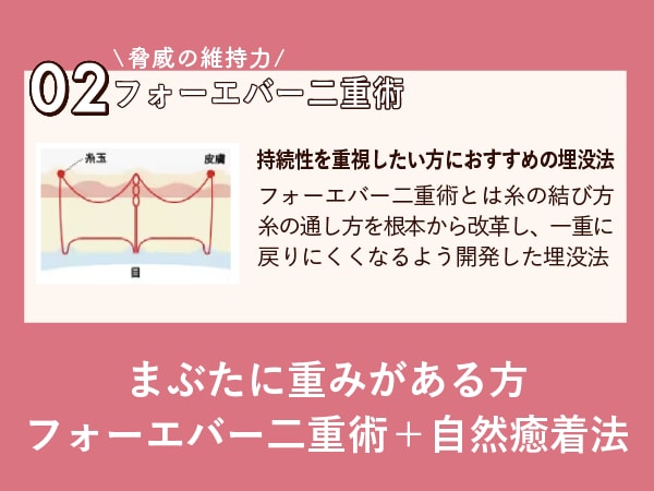 持続性、最重要で一重に戻りにくく工夫された二重術