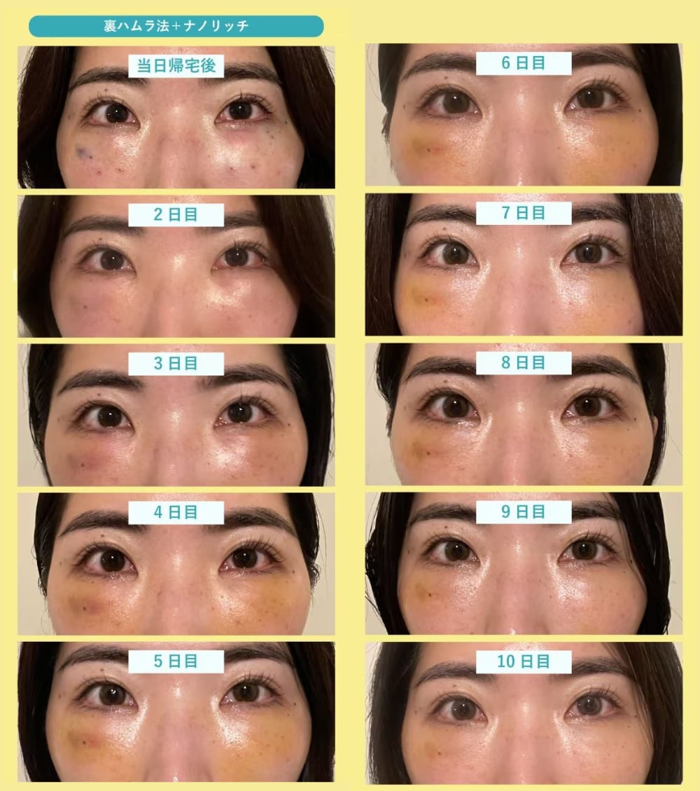 【症例経過】30代前半女性｜裏ハムラ法＋脂肪注入のダウンタイム<br />
