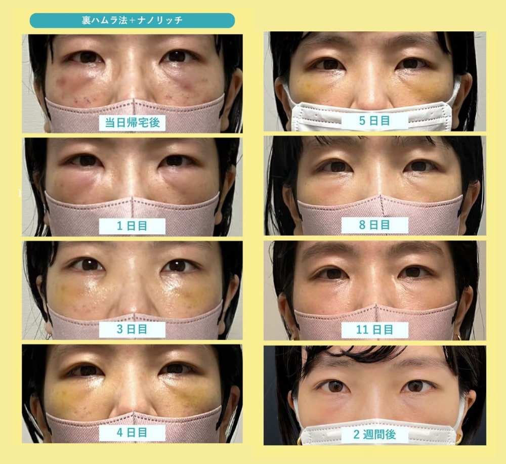 【症例経過】30代女性｜裏ハムラ法＋脂肪注入のダウンタイム