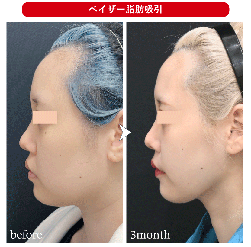 脂肪吸引