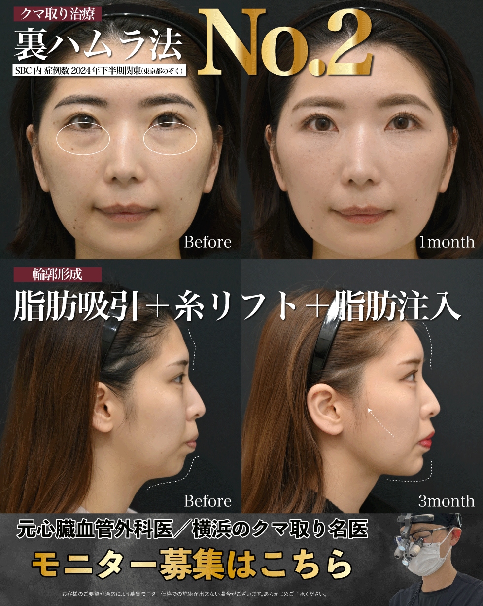 術後の回復が早いクマ取り