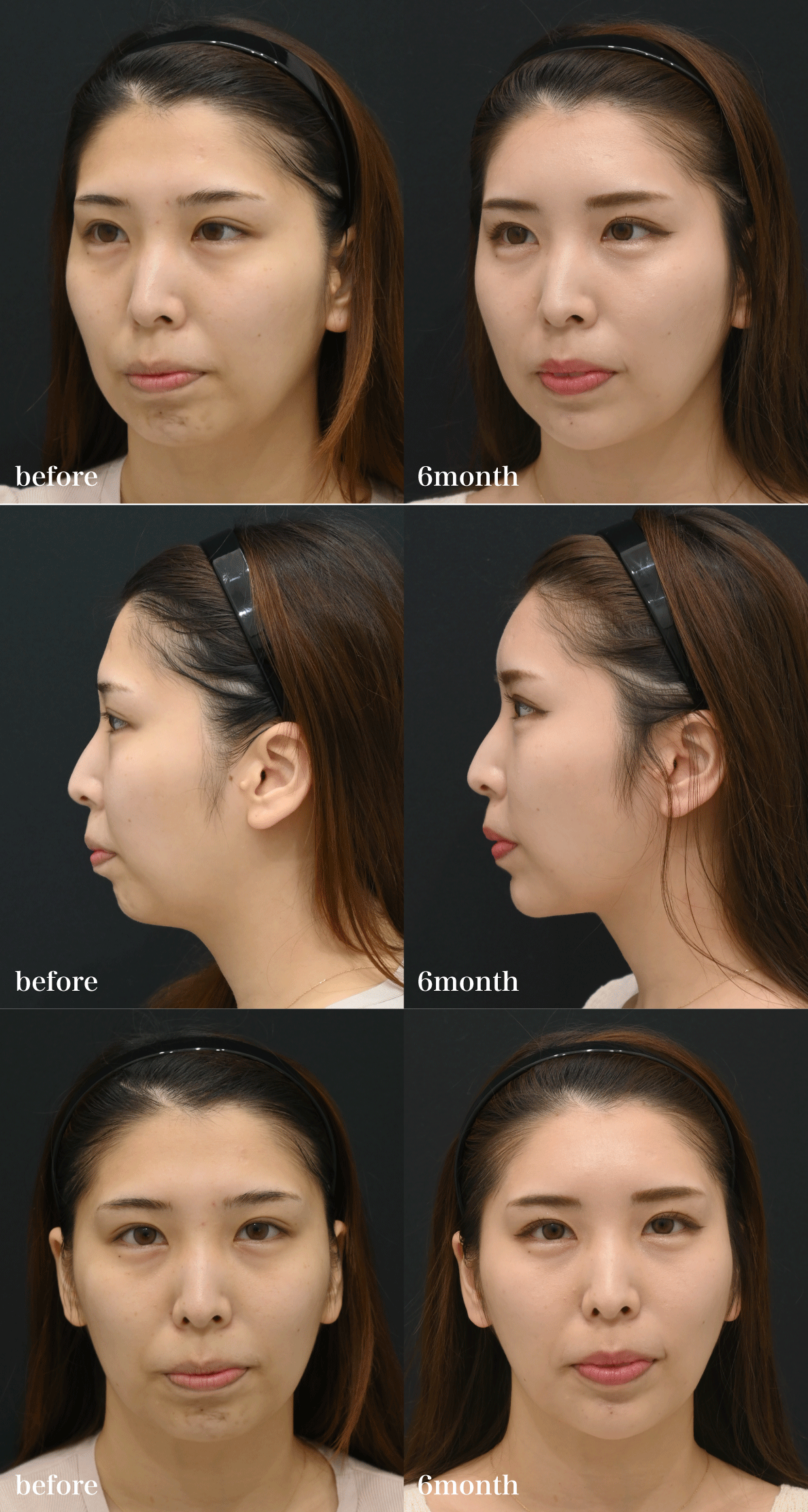 まずは美しすぎる<br />
Before／After