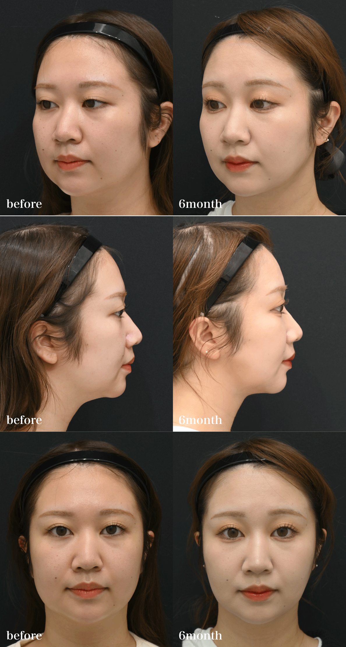 まずは美しすぎる<br />
Before／After