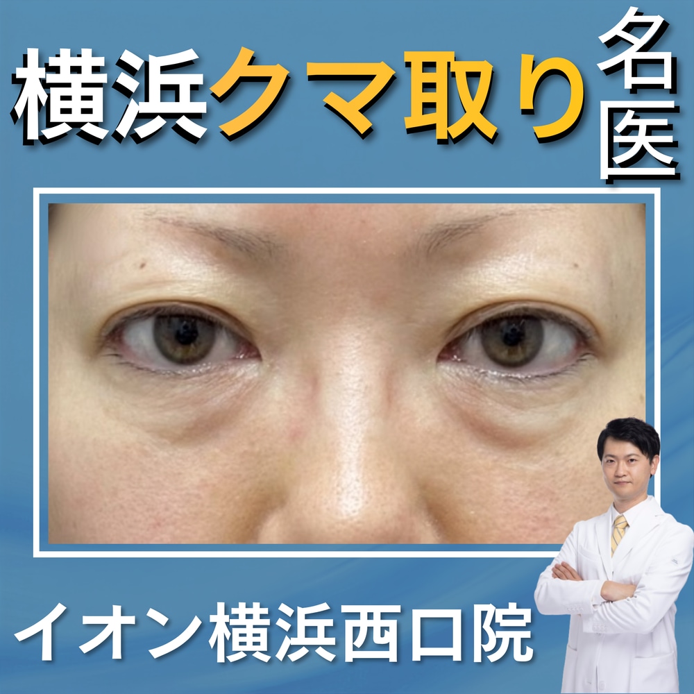 横浜でクマ取り・目の下のたるみ取りなら菅原院長｜湘南美容クリニックイオン横浜西口院
