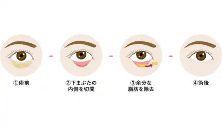 イオン横浜西口の目の下の切らないクマ・たるみ取り（脱脂）とは<br />

