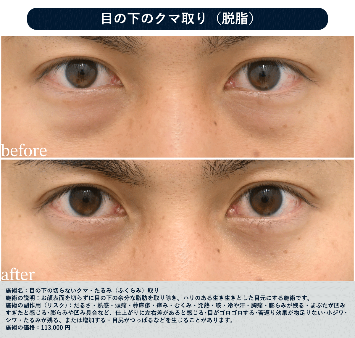 30代 脱脂