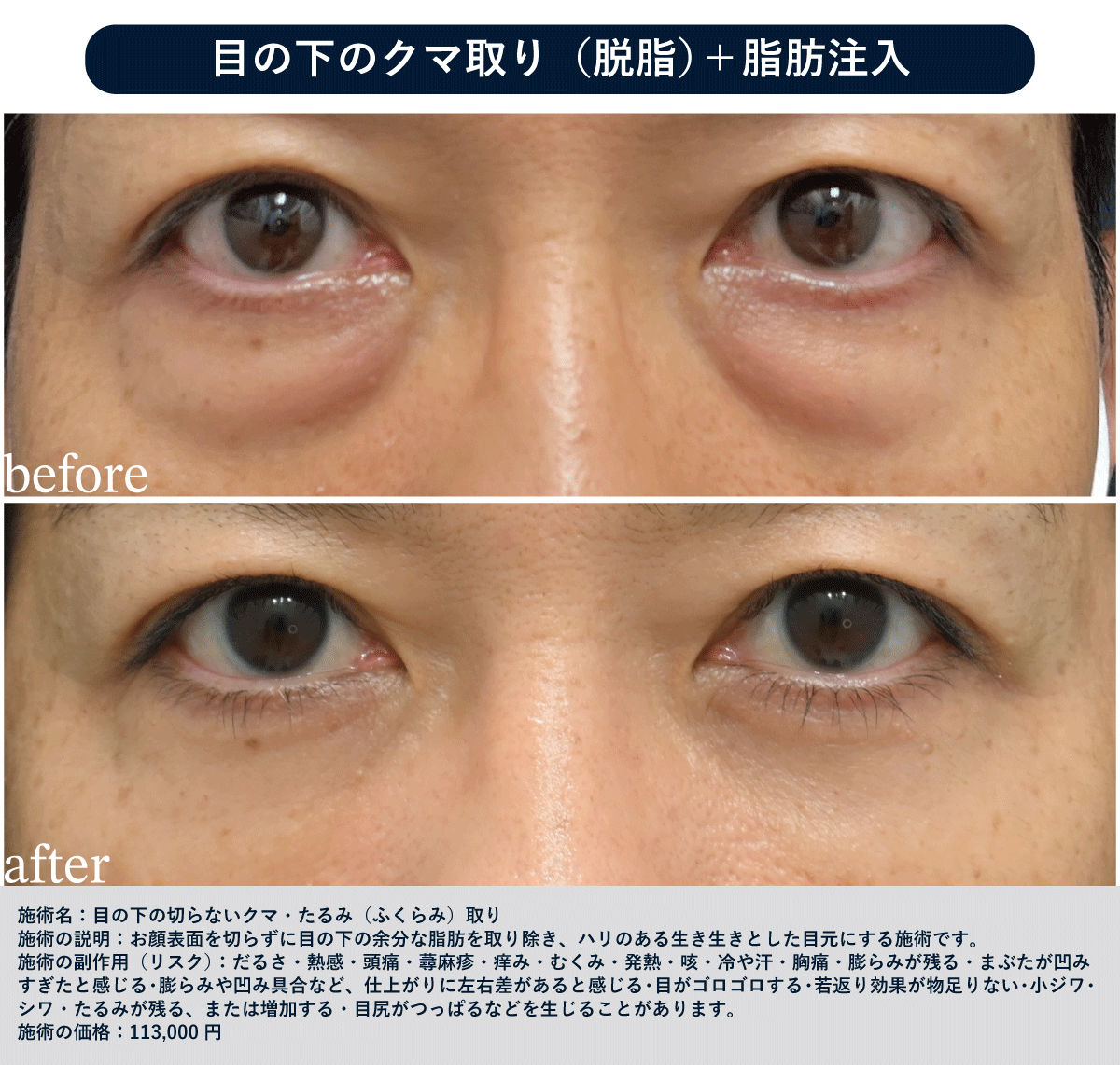 50代 脱脂＋脂肪注入