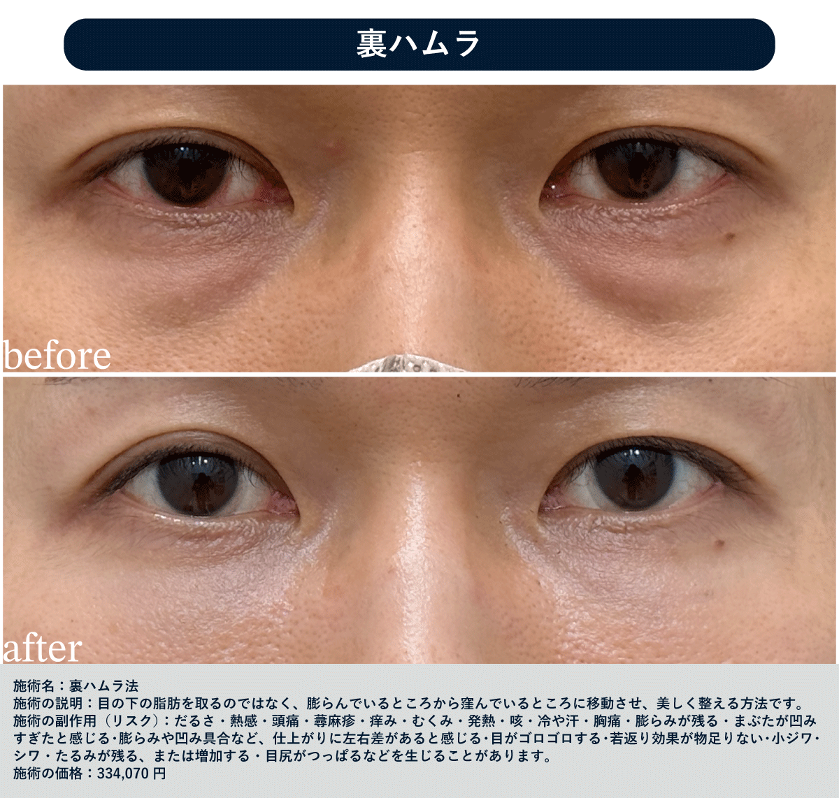 30代 裏ハムラ
