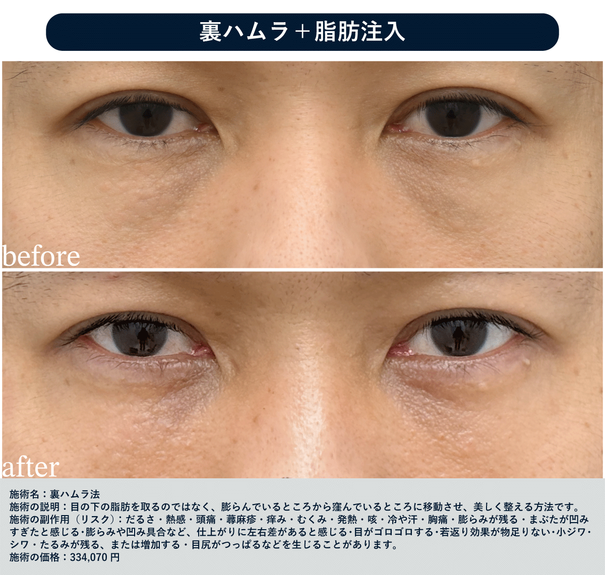40代 裏ハムラ＋脂肪注入