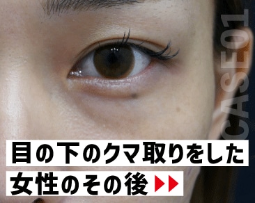 【実例】クマ取りしたあと、どうなった？？