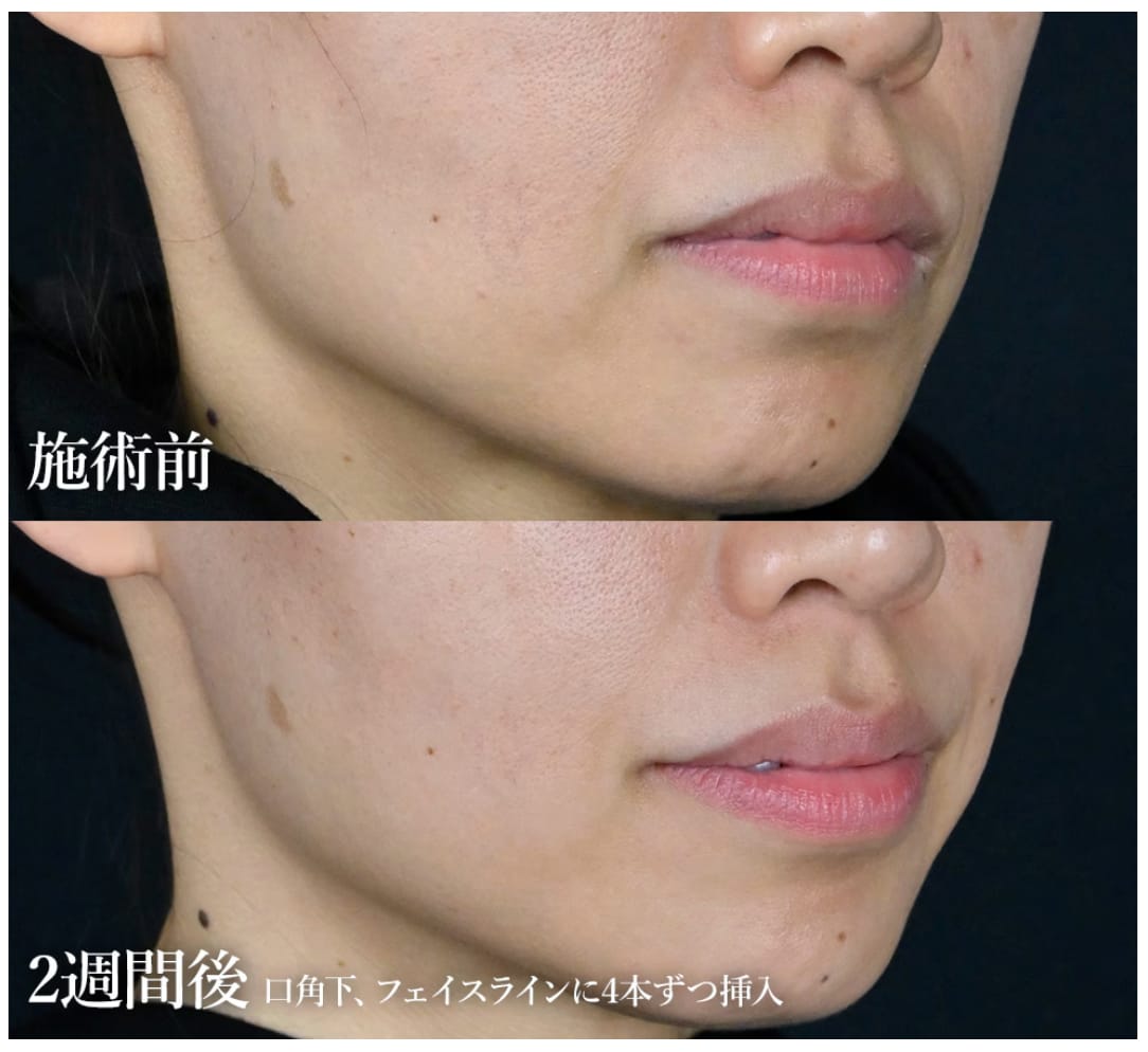 女優注射成分が入ってます😳