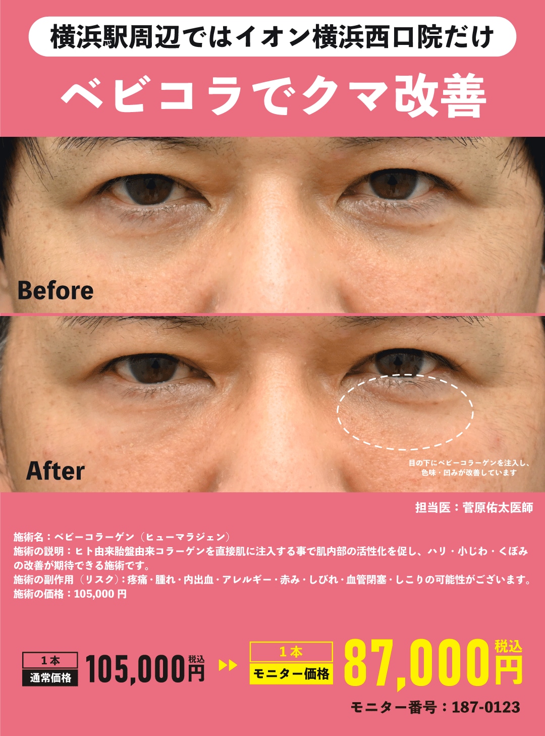 外科治療なし❗️ベビーコラーゲンモニター募集中