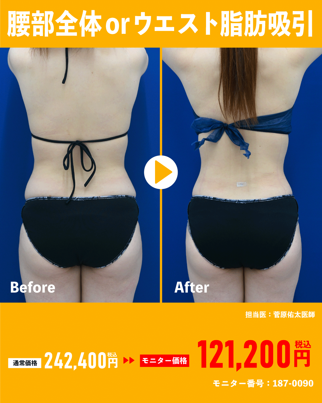 【人数限定】脂肪吸引50%off🈹