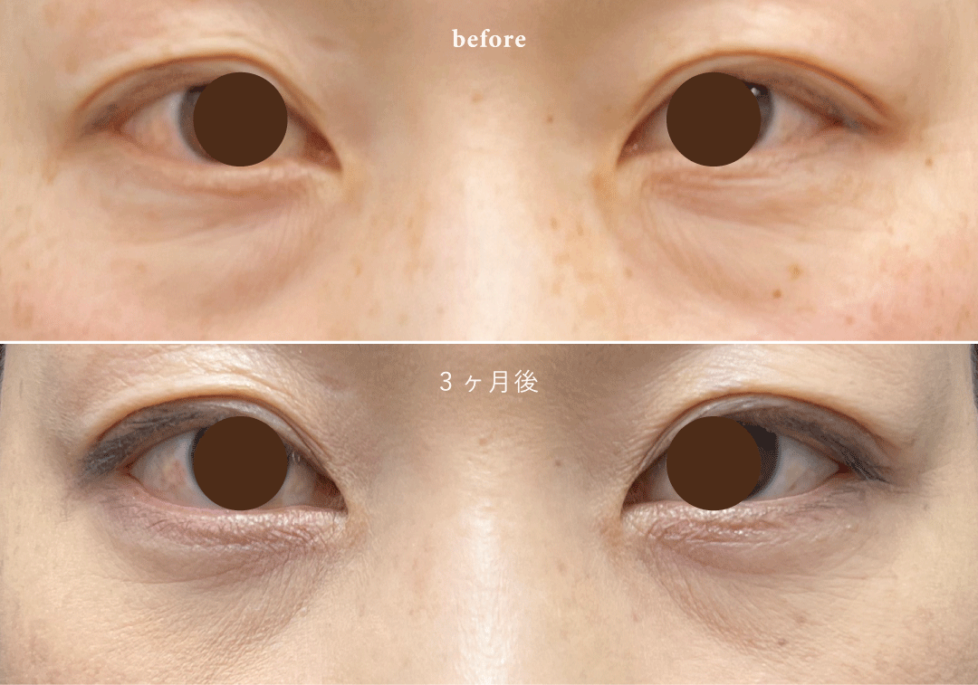 脱脂したことで<br />
クマが悪化することがある