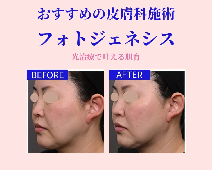 フォトジェネシス