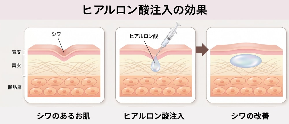 【シワ・ほうれい線が気になる方】ボトックス・ヒアルロン酸