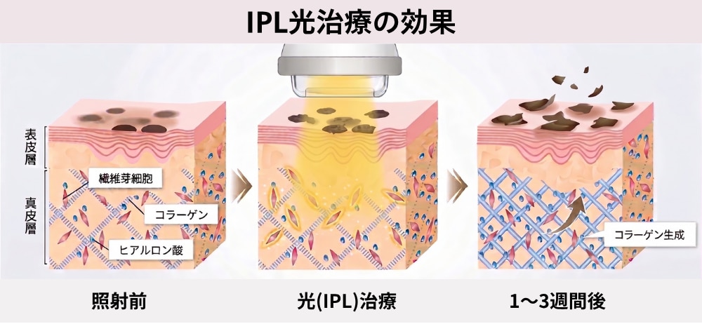 【シミ・そばかすが気になる方】IPL光治療・レーザートーニング