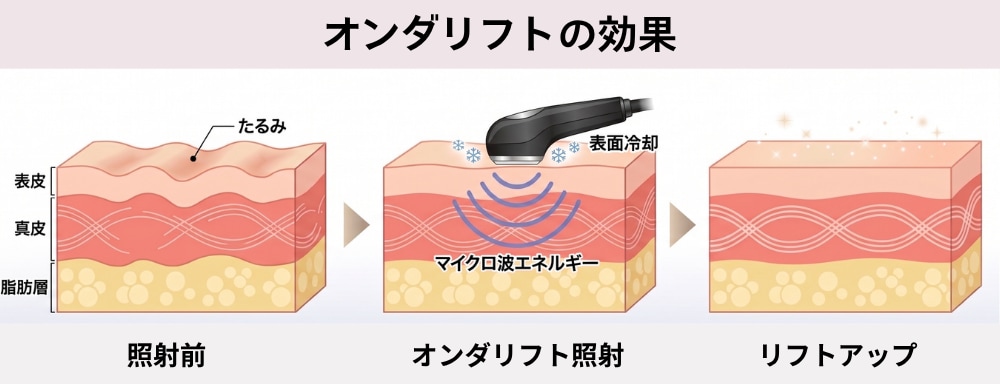 【あご下・頬の脂肪たるみが気になる方】オンダリフト<br />
