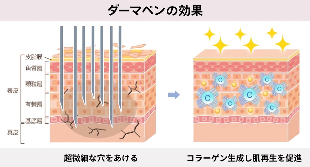 【毛穴が気になる方】ダーマペン