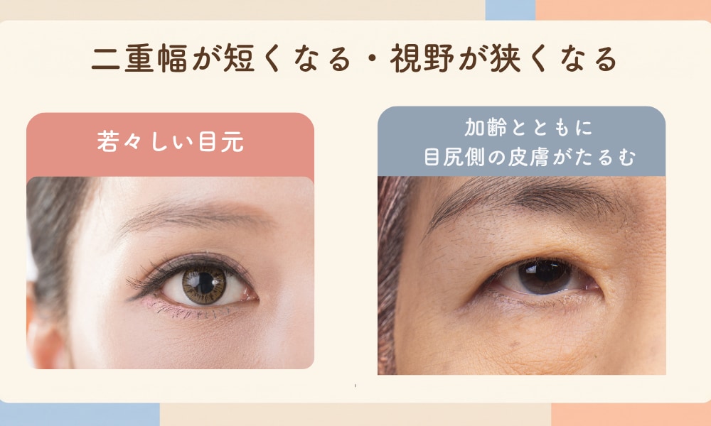 1. 加齢に伴う上まぶたの皮膚のたるみ