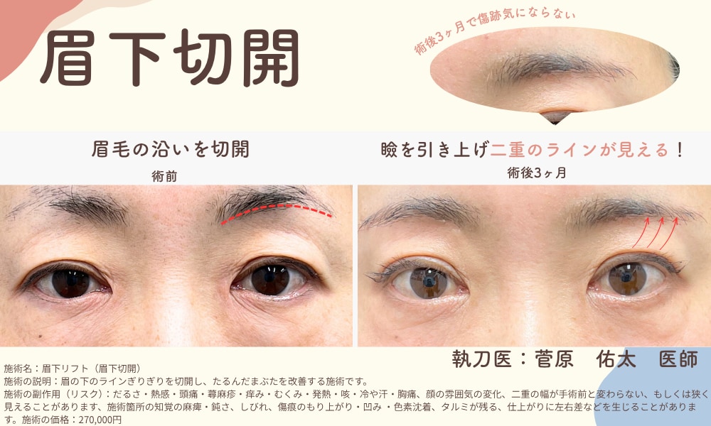 眉下リフト