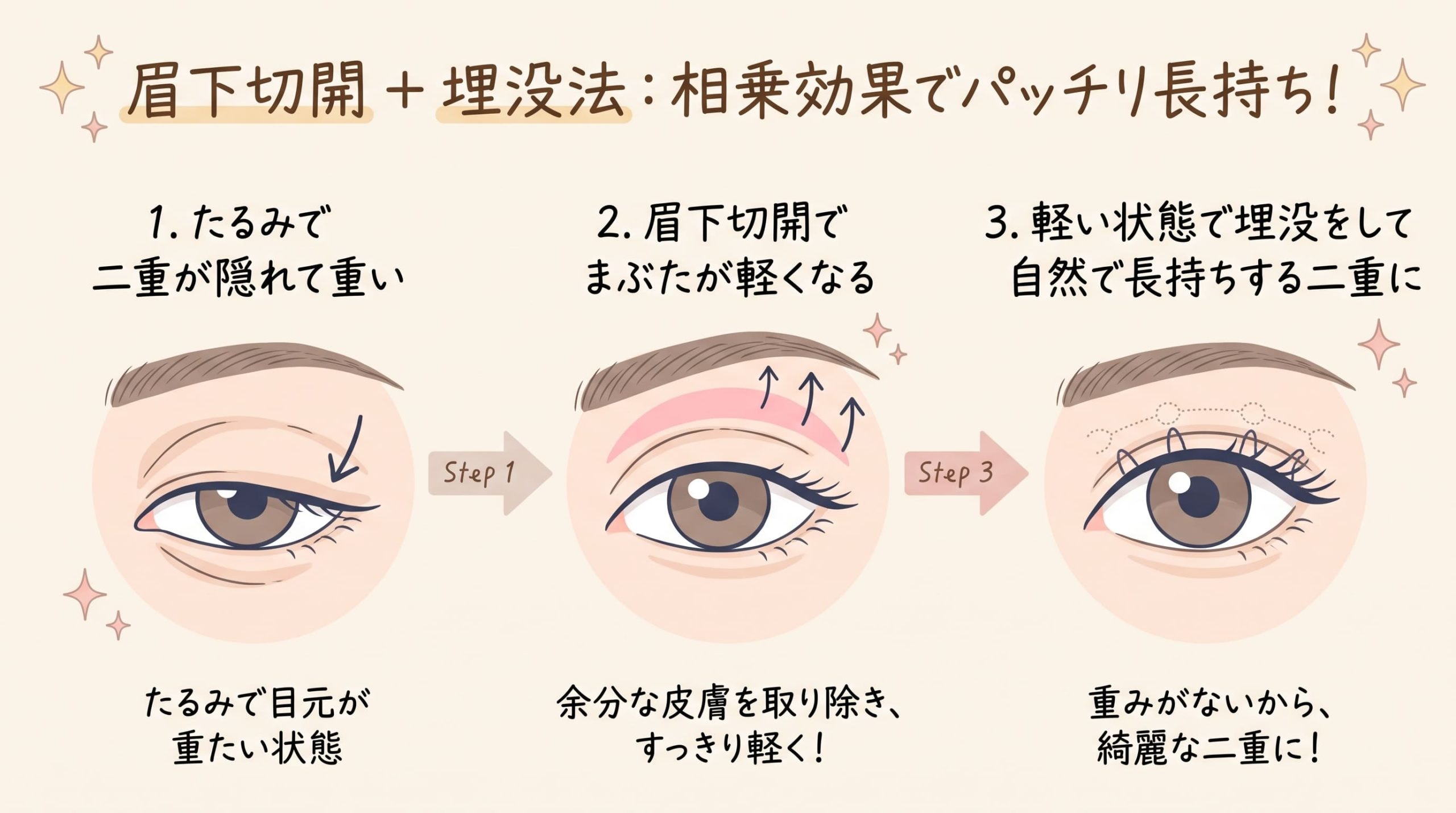 1. 二重幅をよりクッキリさせたいなら「眉下切開 ＋ 埋没法」
