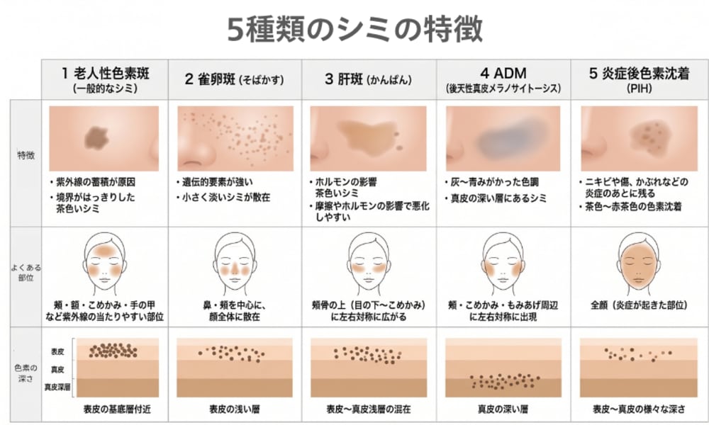 老人性色素斑（一般的なシミ）｜輪郭のはっきりした茶色いシミ<br />
