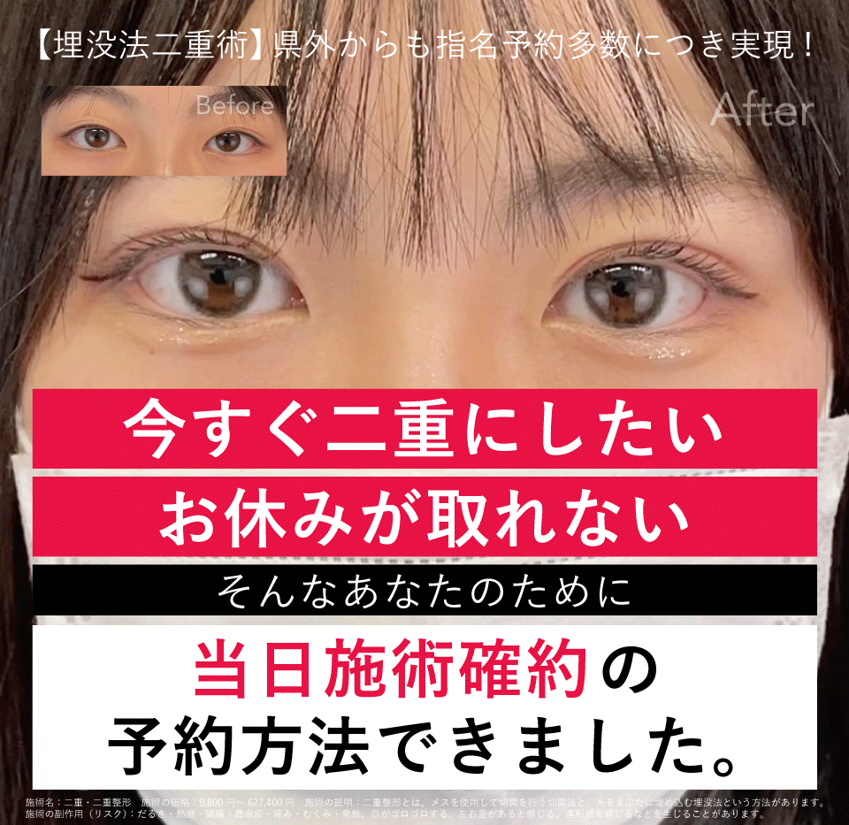 【二重埋没法】即日二重にしたい方の予約方法★