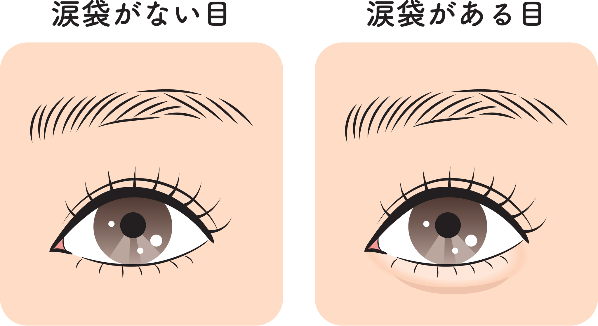 涙袋ヒアルロン酸