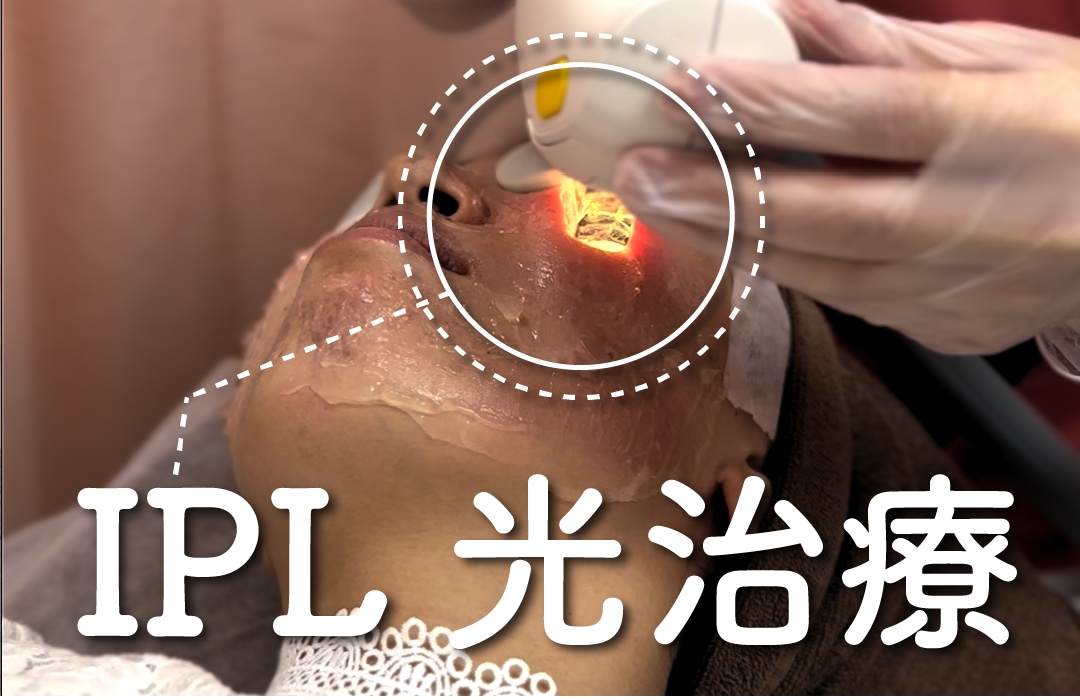 美容のプロが惚れ込むIPL治療の魅力「実際に受けてる社員さんの様子も見れちゃう！」