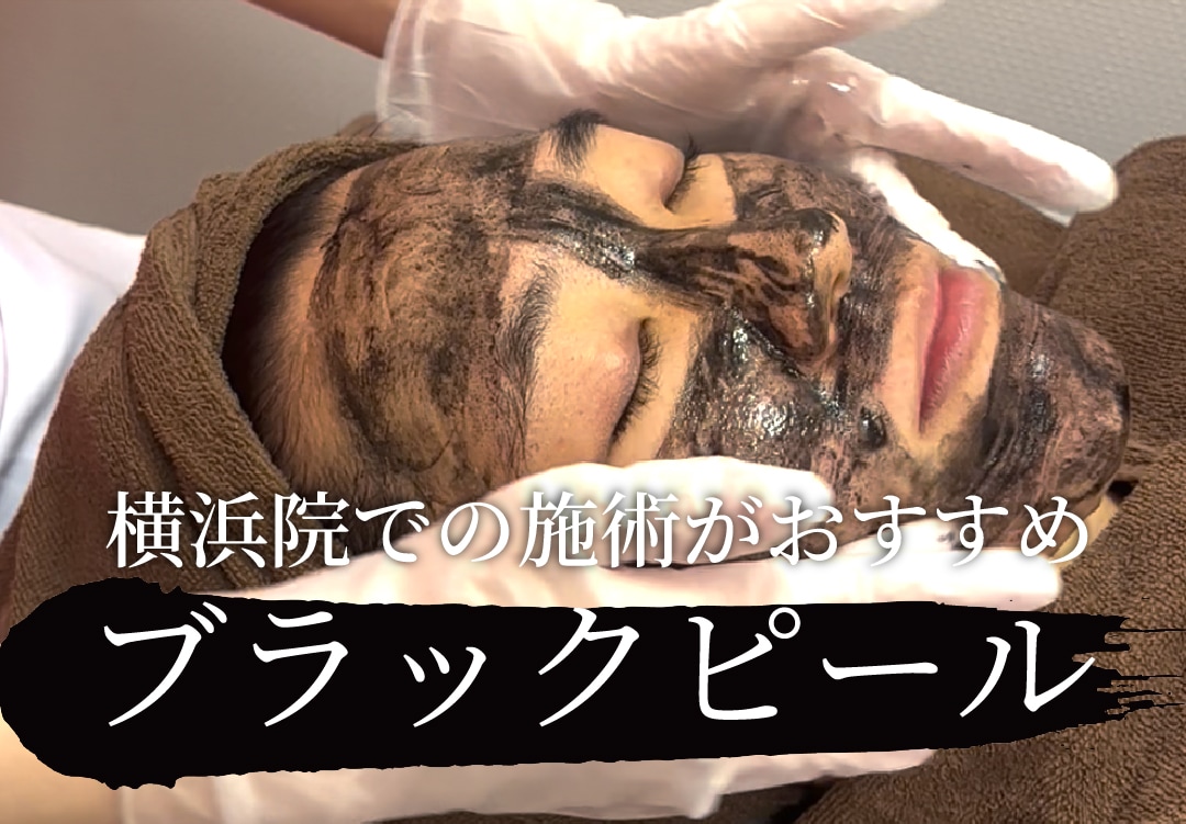 ブラックピールで毛穴・くすみ・小じわ改善！〜LDM水玉リフティングとの相乗効果で透明感アップ〜【SBC横浜院】