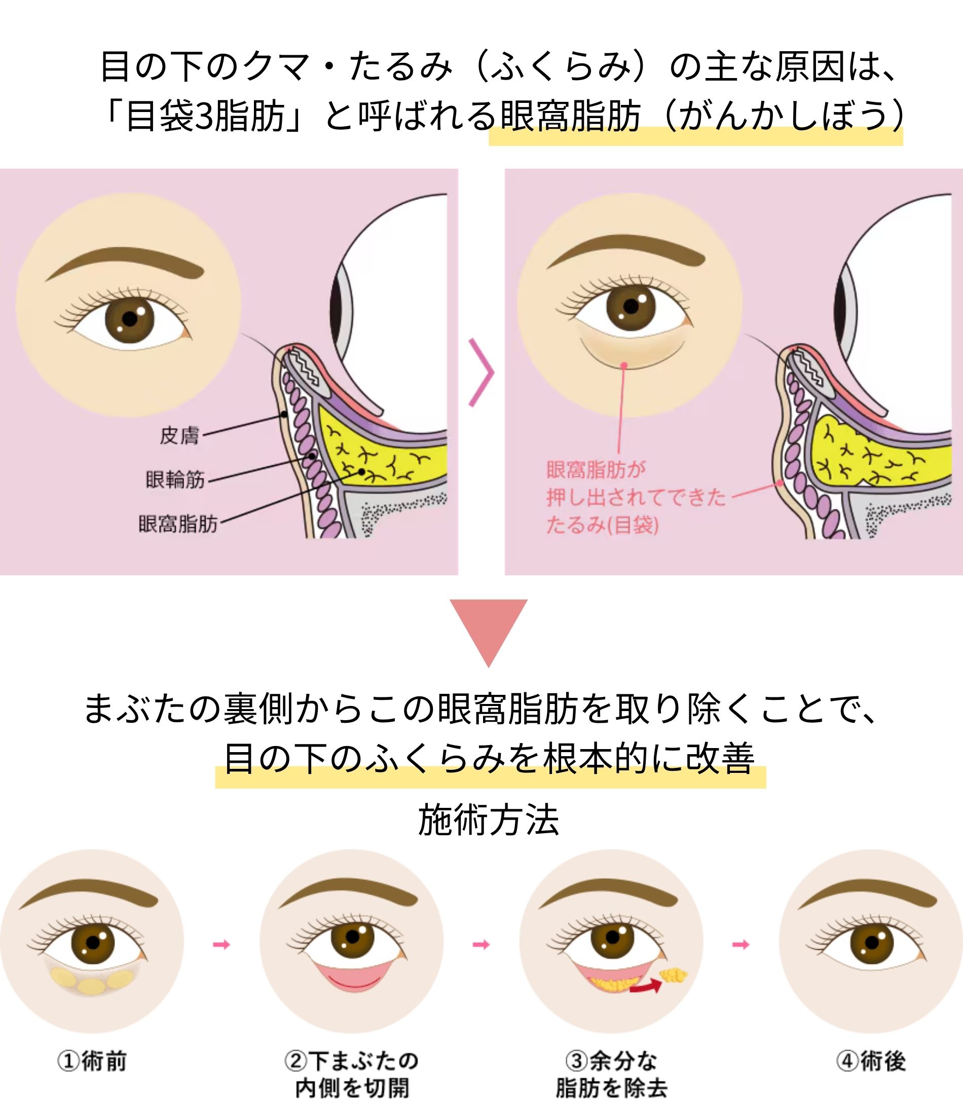 話題の「切らないクマ取り」とは?