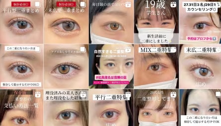 1万件以上の目元整形実績から、最適な目頭切開をご提案