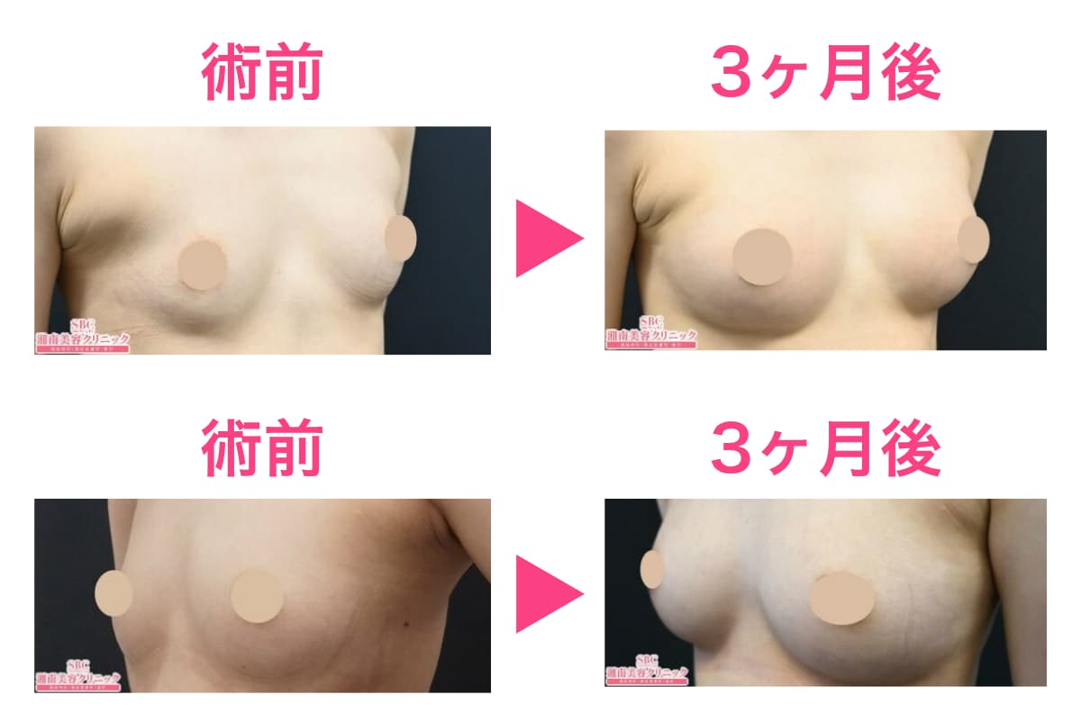 20代女性の脂肪注入豊胸の症例