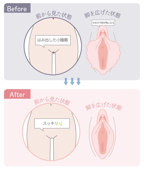 小陰唇の余分な部分を切除する施術