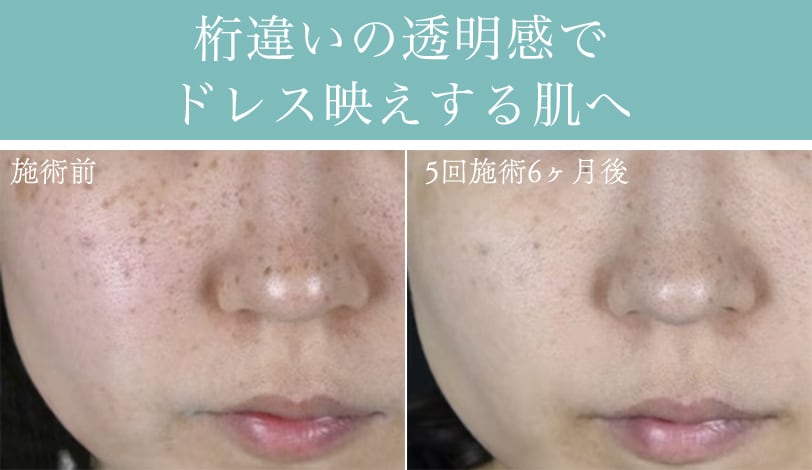 IPL光治療