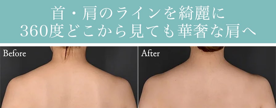 肩ボトックス