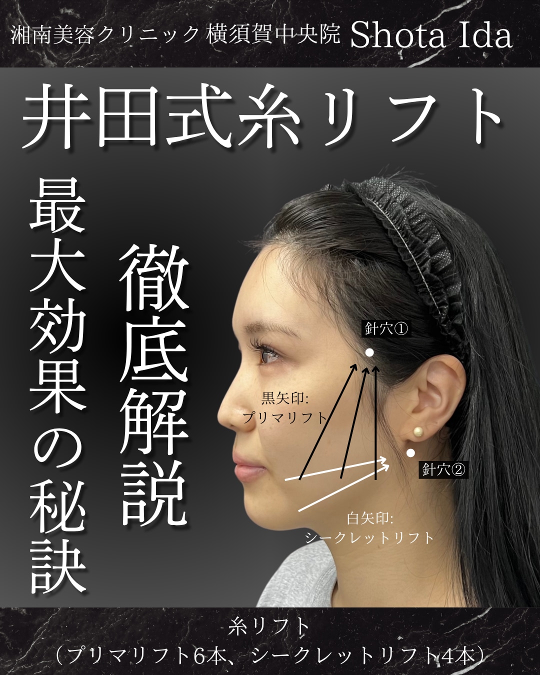 【井田式糸リフト】徹底解説！最大効果の秘訣は◯◯