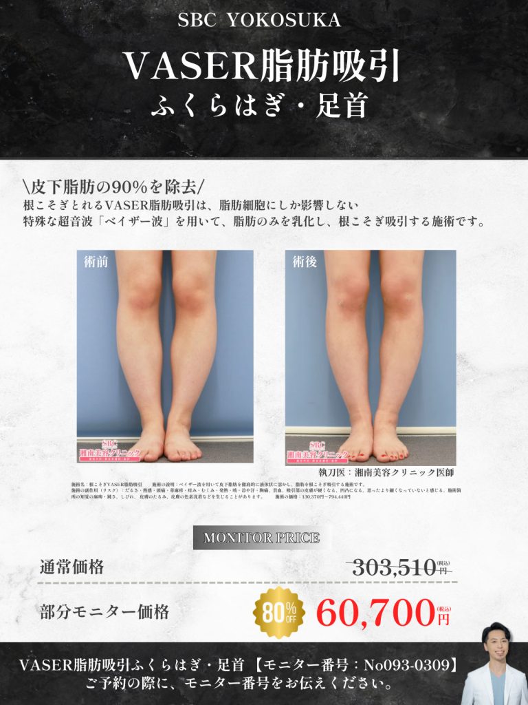 激安　脚痩せ・ふくらはぎ痩せ　モニター募集