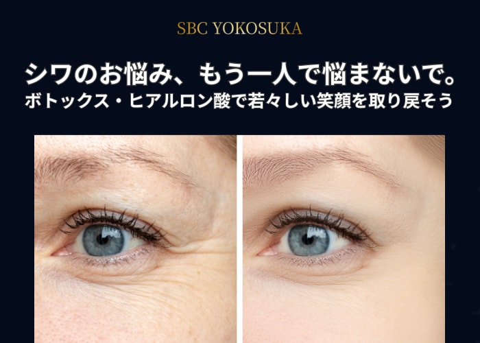 【横須賀中央院】シワのお悩み、もう一人で悩まないで！ボトックス・ヒアルロン酸で若々しい笑顔を取り戻しませんか？
