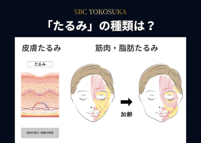 私のたるみの種類って何?