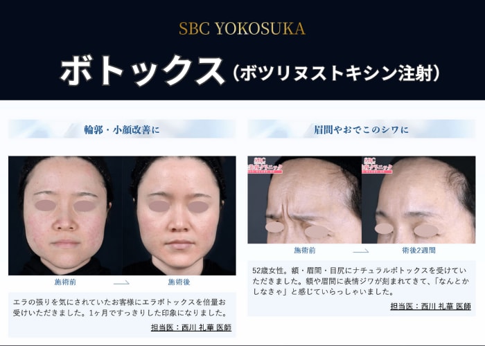 ボトックス（ボツリヌストキシン注射）とは？