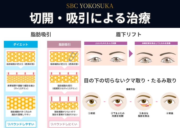 切開・吸引による本格治療部門🥇