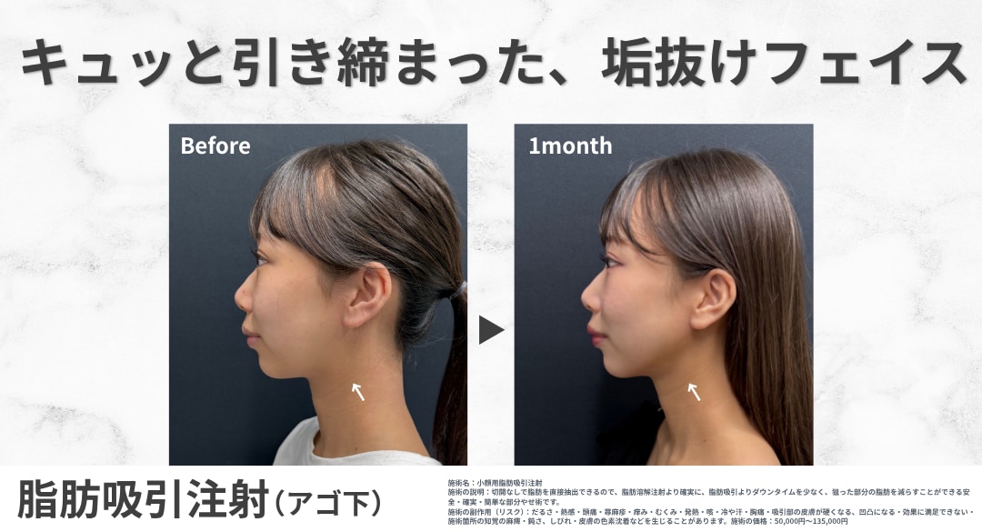 小顔脂肪吸引で半永久的なフェイスラインを手に入れる