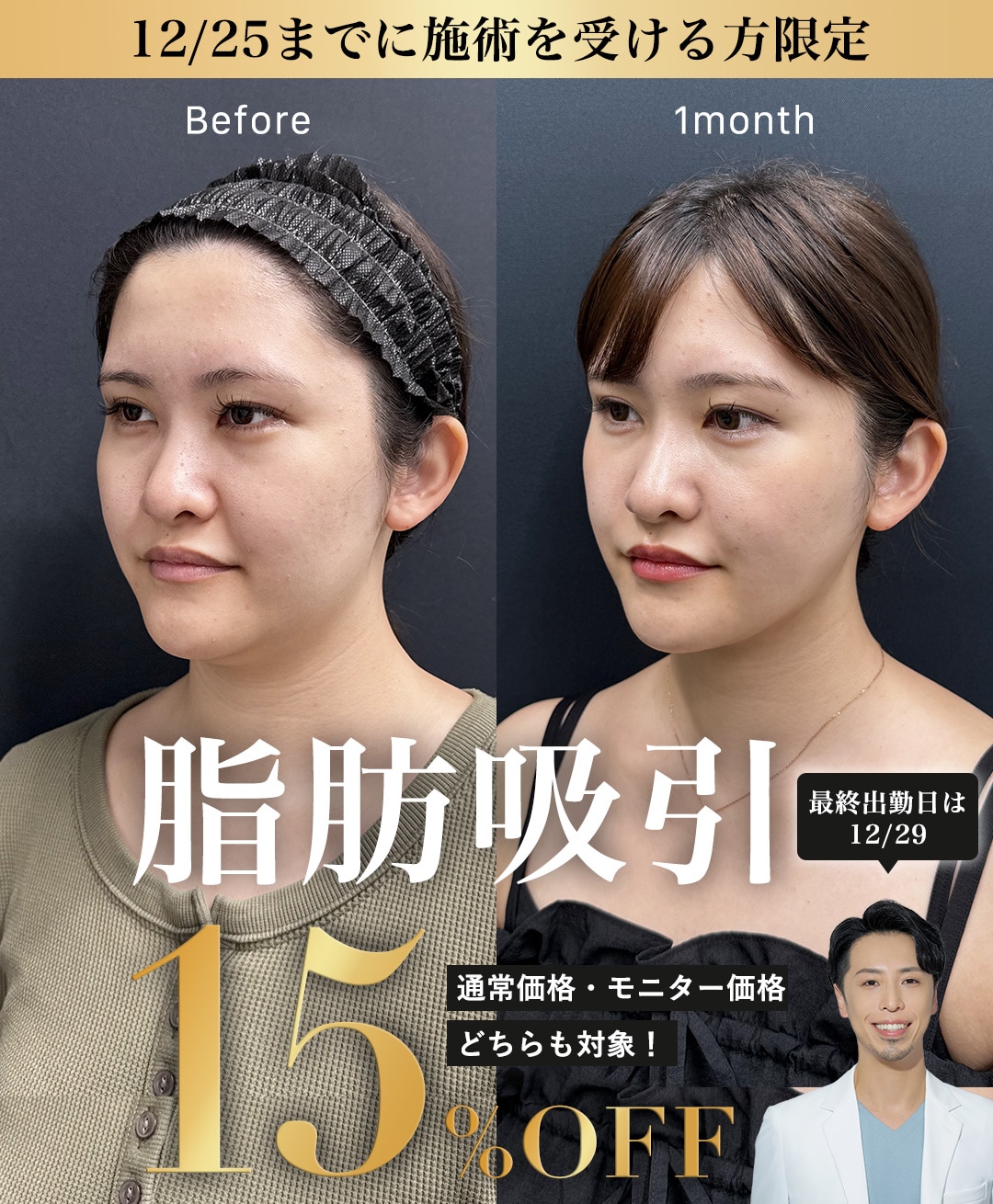 【脂肪吸引】15%OFFキャンペーン✨