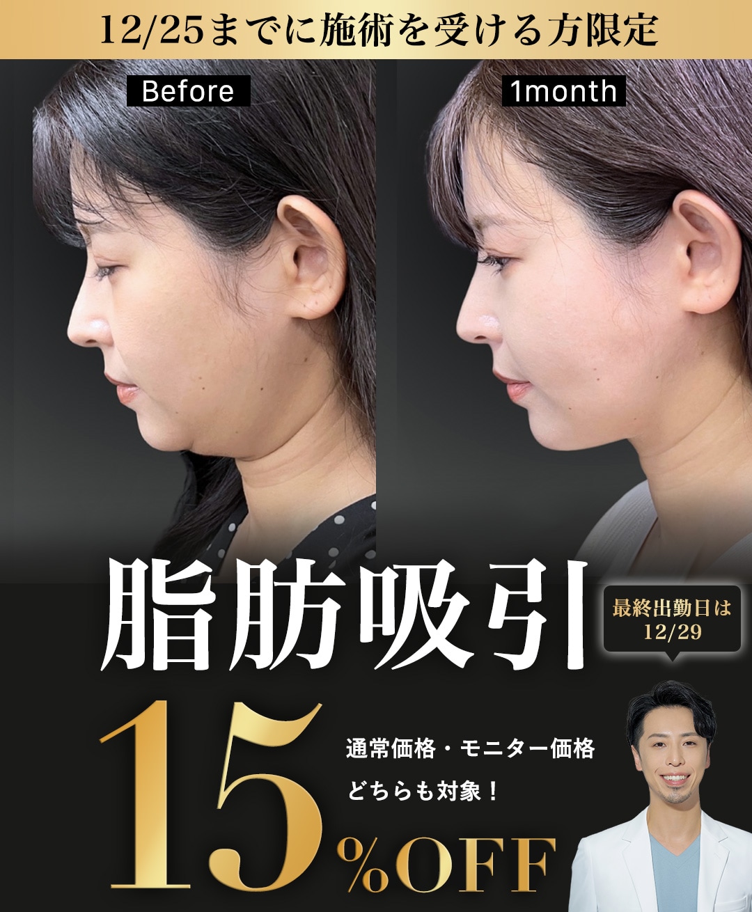 【12/25まで】脂肪吸引15%OFF