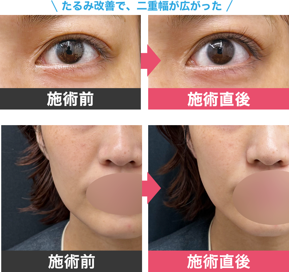 切らずに自然に若返る