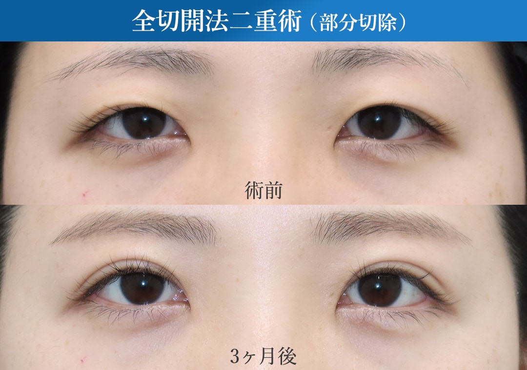 内部構造へのアプローチ｜ただ二重にするだけでなく「目の開き」から変える